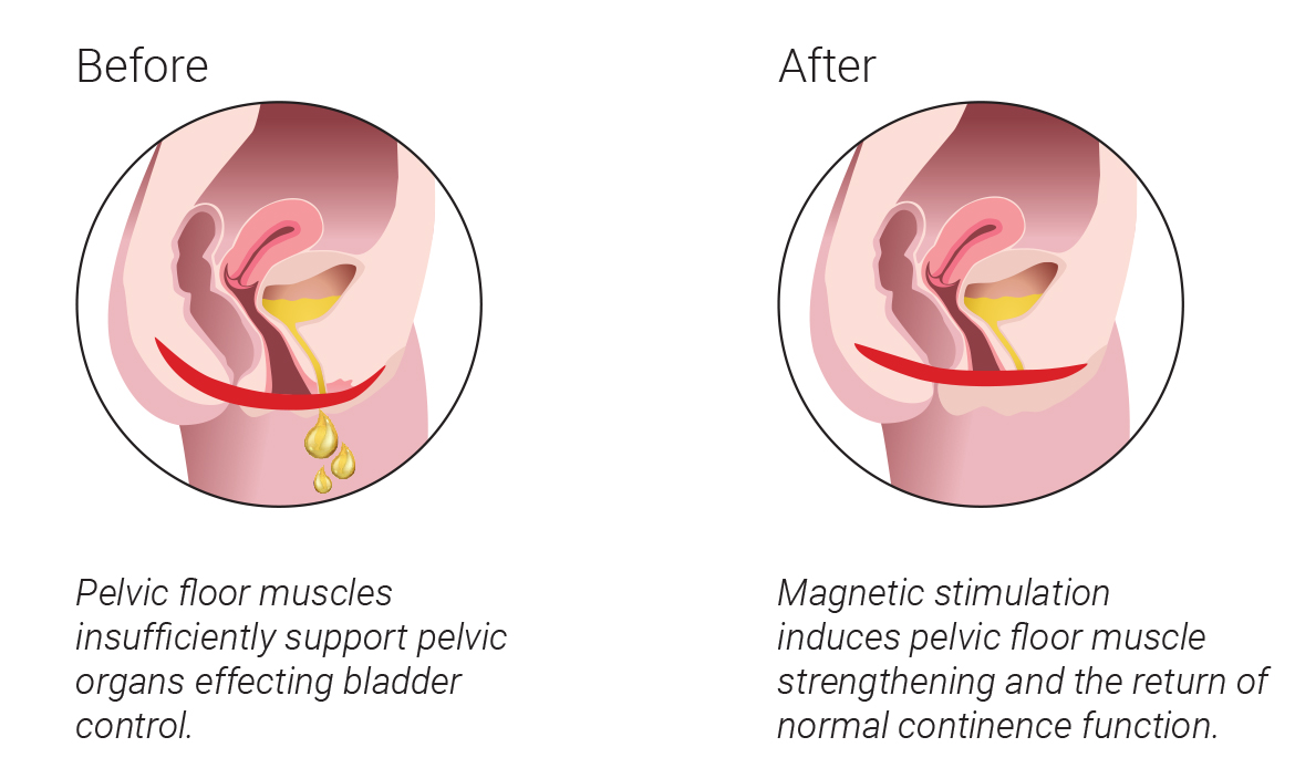 pelvic floor muscle therapy in Singapore